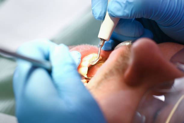 Best Emergency Dentist for Knocked-Out Tooth in Country Club Estates, GA